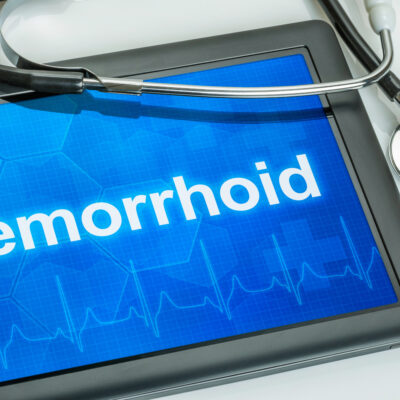 5 Ways to Prevent Hemorrhoids